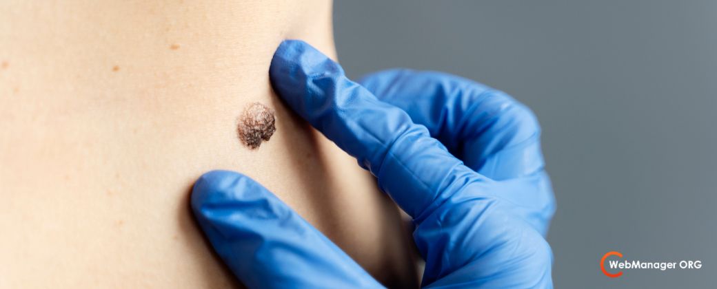 איך לבחור מנתח מוהס - בדיקת נקודת חן חשודה. בצד ימין למטה לוגו אתר webmanager